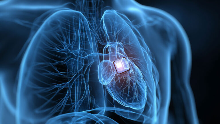 Digital rendering of a human torso showing the heart and surrounding blood vessels, with a small medical device implanted in the heart area.