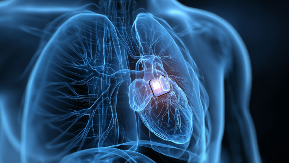 Digital rendering of a human torso showing the heart and surrounding blood vessels, with a small medical device implanted in the heart area.